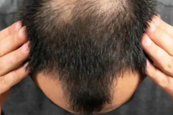 7 Ways to Prevent Hair Loss